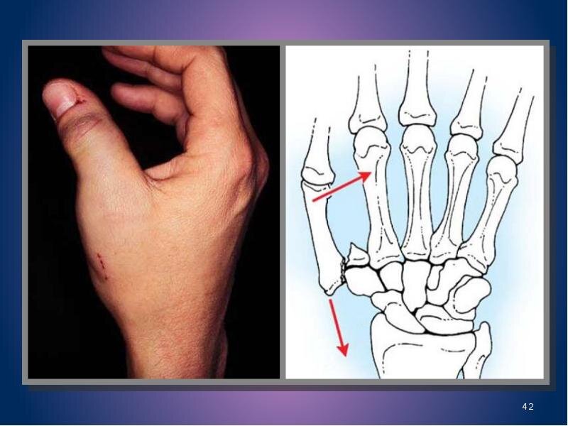 Трещина в кисти. Перелом Беннета 1 пястной кости. Перелом Беннета со смещением. Перелом первой пястной кости перелом Беннета.