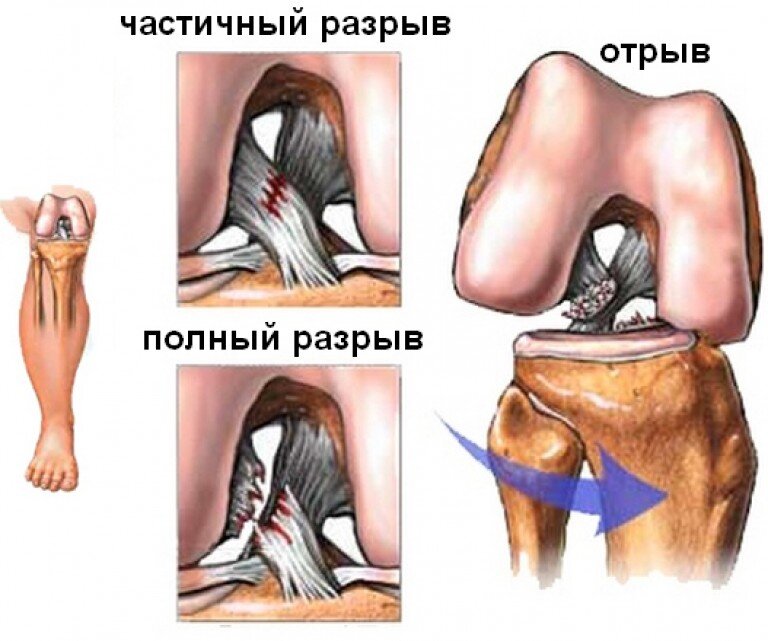 Пластика ПКС реабилитация