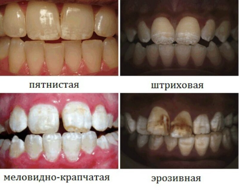 3 причины гипоплазии эмали 