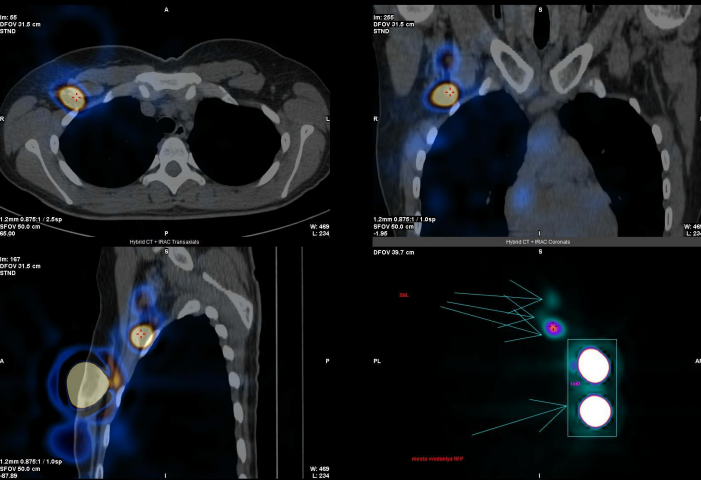 Визуализация сторожевых лимфоузлов
