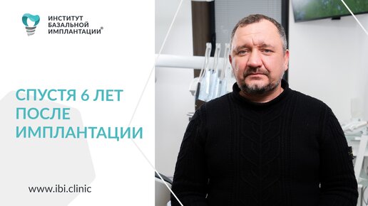 6 лет после имплантации зубов в ИБИ/Замена сегментов