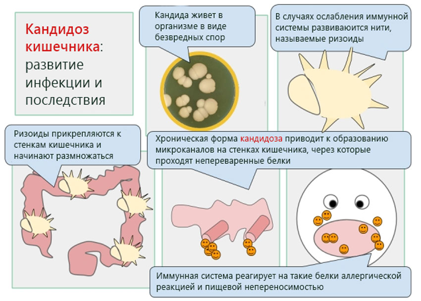 Молочница желудка. Кандидоз кишечника симптомы. Грибы кандида в кишечнике. Дрожжеподобные грибы в кишечнике. Грибки в кишечнике у ребенка.