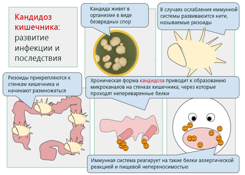 Кандида лечится. Кандидоз кишечника симптомы. Грибы кандида в кишечнике. Дрожжеподобные грибы в кишечнике.