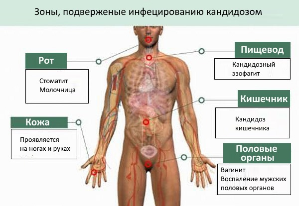 Молочница (кандидоз) - диагностика и лечение болезни
