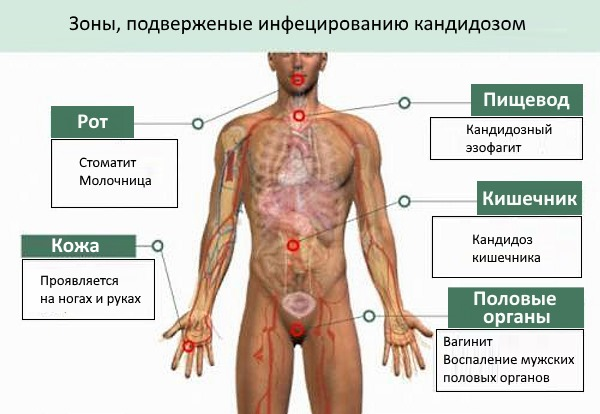 Кандидоз у детей: причины, симптомы, лечение