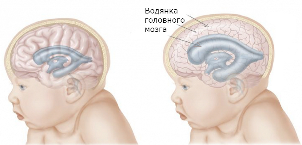 Гидроцефалия головного мозга у взрослых и детей: симптомы и лечение