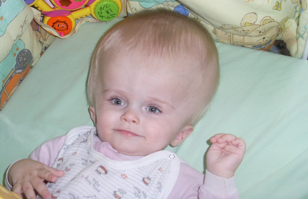 Ребенок 3 года бледный. Гидроцефальная форма головы у ребенка. Прогрессирующая гидроцефалия.