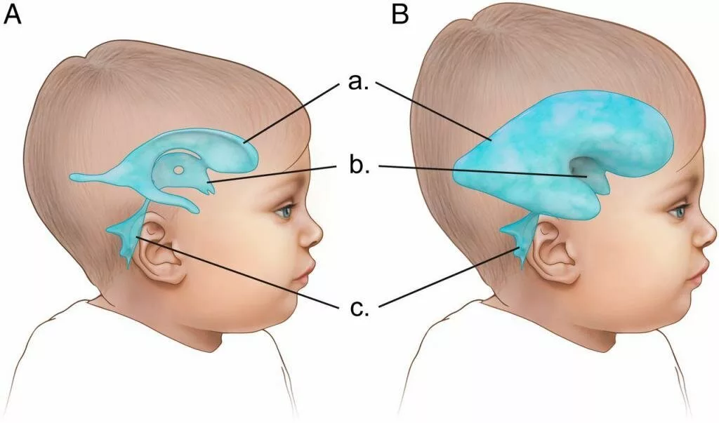 Внутриутробное недоразвитие головного мозга. Гидроцефалия водянка головного мозга. Гидроцефалия головного мозга у ребенка. Гидроцефальный синдром у новорожденного.