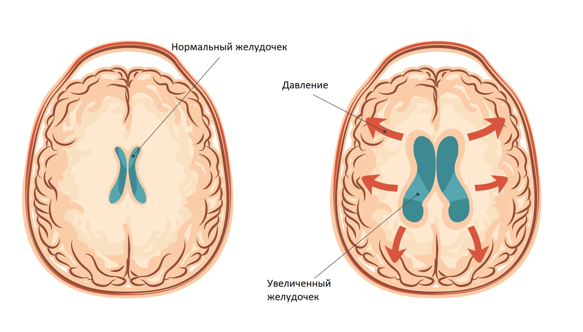 Церебральная гидроцефалия. Гидроцефалия водянка головного мозга. Гидроцефалия желудочков головного. Гидроцефалия норма желудочков. Гидроцефалия боковых желудочков.