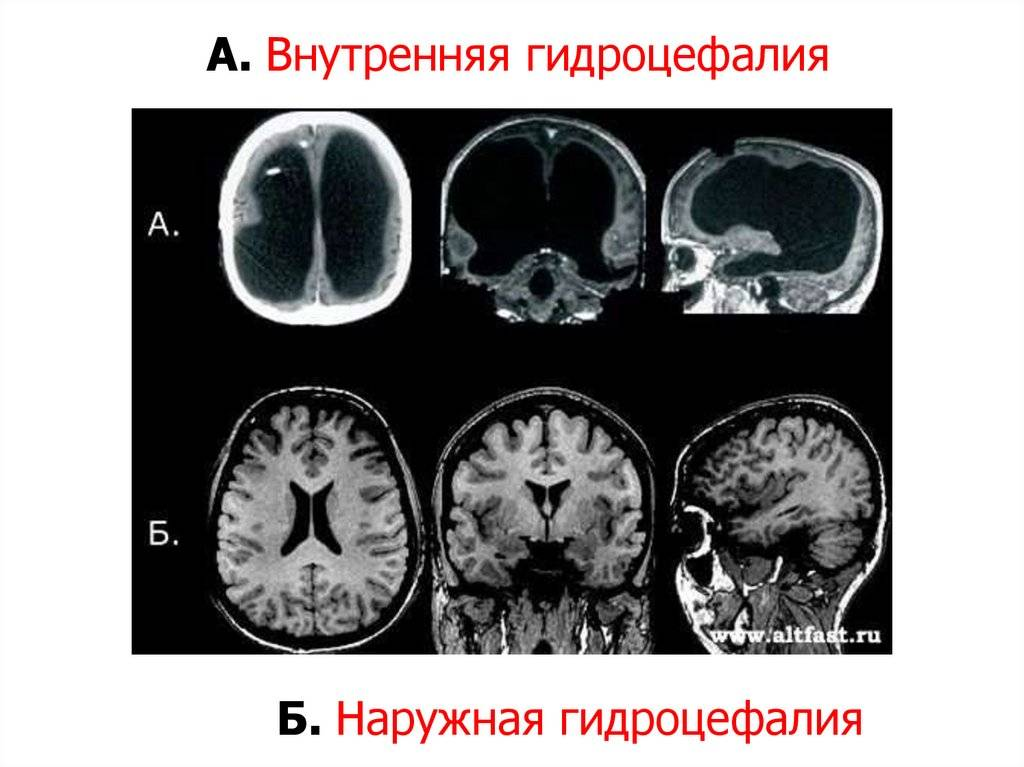 Заместительная наружная гидроцефалия головного мозга: …