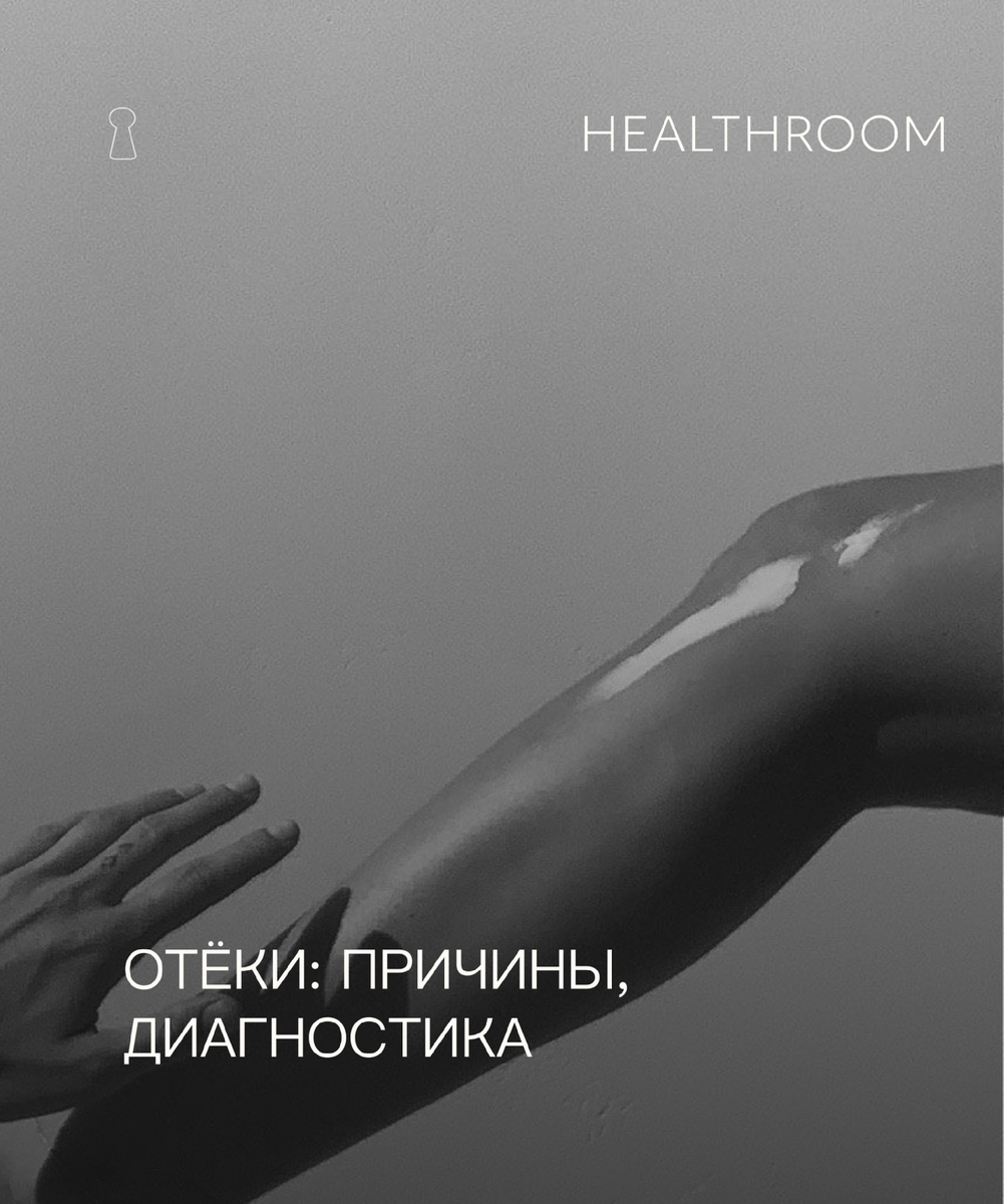 Отеки: причины появления, диагностика. Как избавиться от отеков. |  Healthroom - Центр здоровья | Дзен