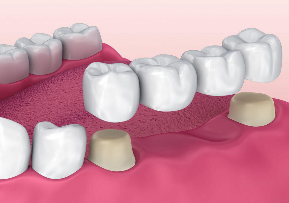 Мостовидный протез на 1 зуб. Протезы с пружинами и магнитами. Монолитный зубной имплант. Съемный протез на нижнюю челюсть. Протезирование зубного ряда.