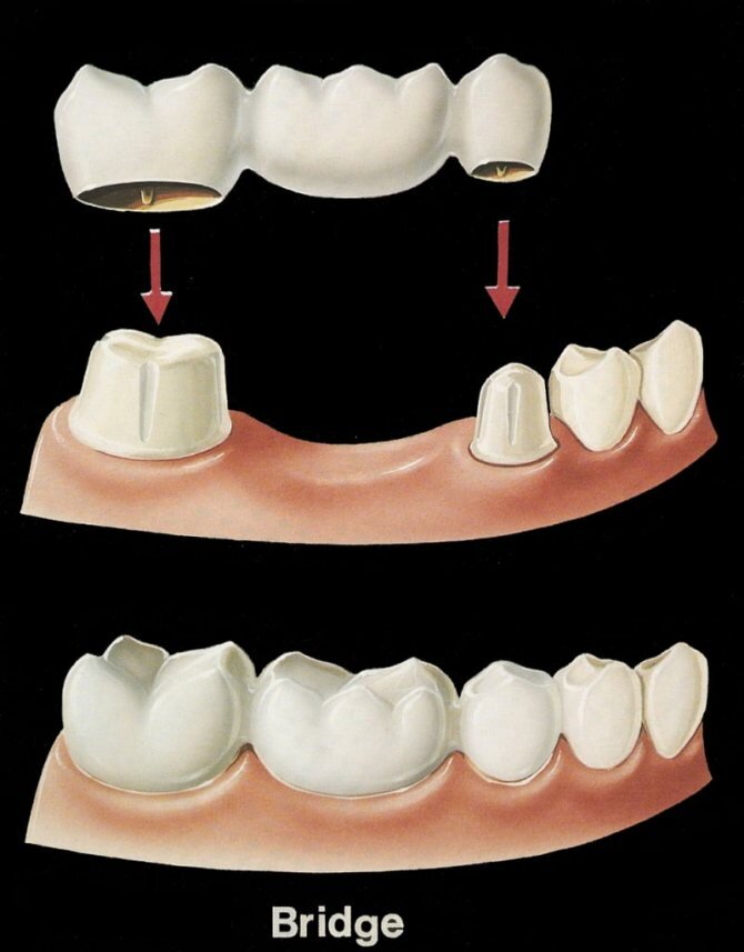 Временный зубной мост. Металлокерамический мостовидный протез. Несъемные мостовидные протезы. Несъёмный мостовидный протез челюсти. Несъемный мостовидный протез.
