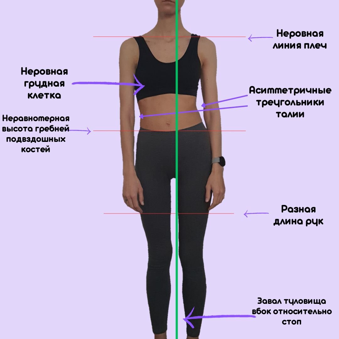 Чеклист для оценки осанки и сколиоза