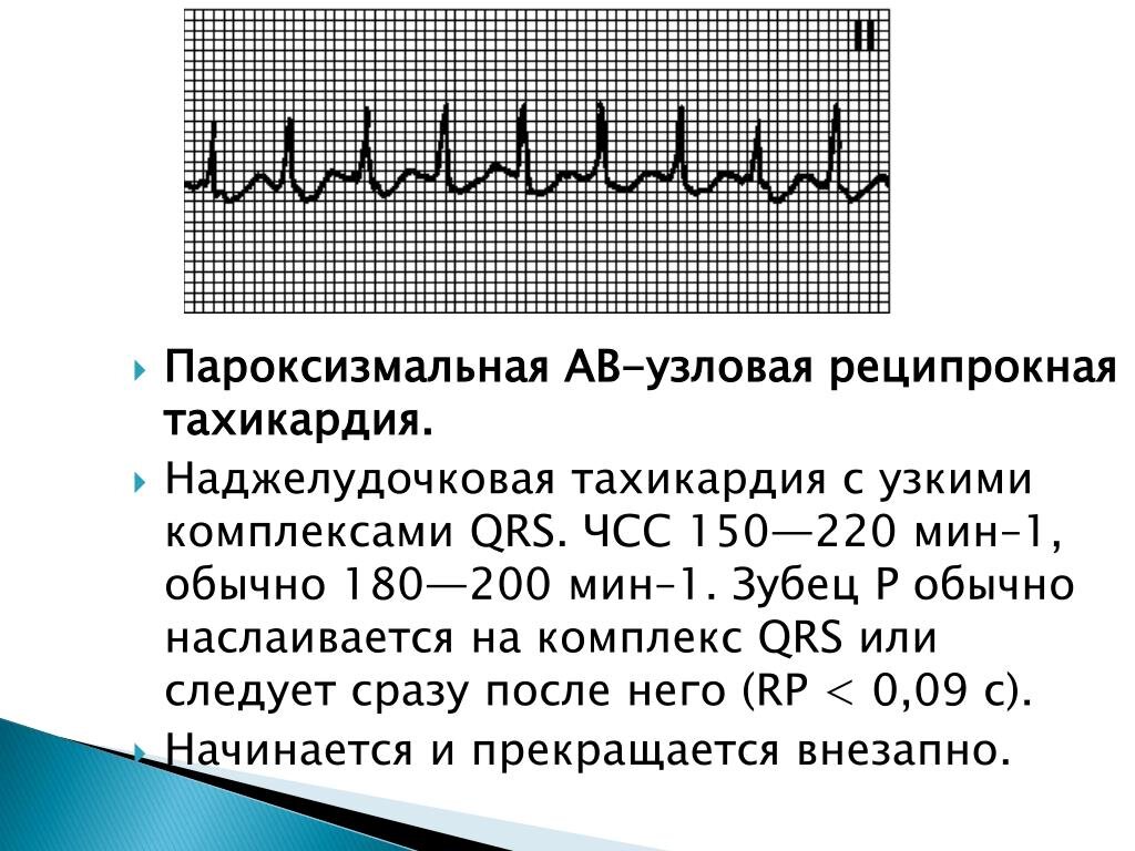 Тахикардия - причины, симптомы, диагностика, лечение у детей и взрослых