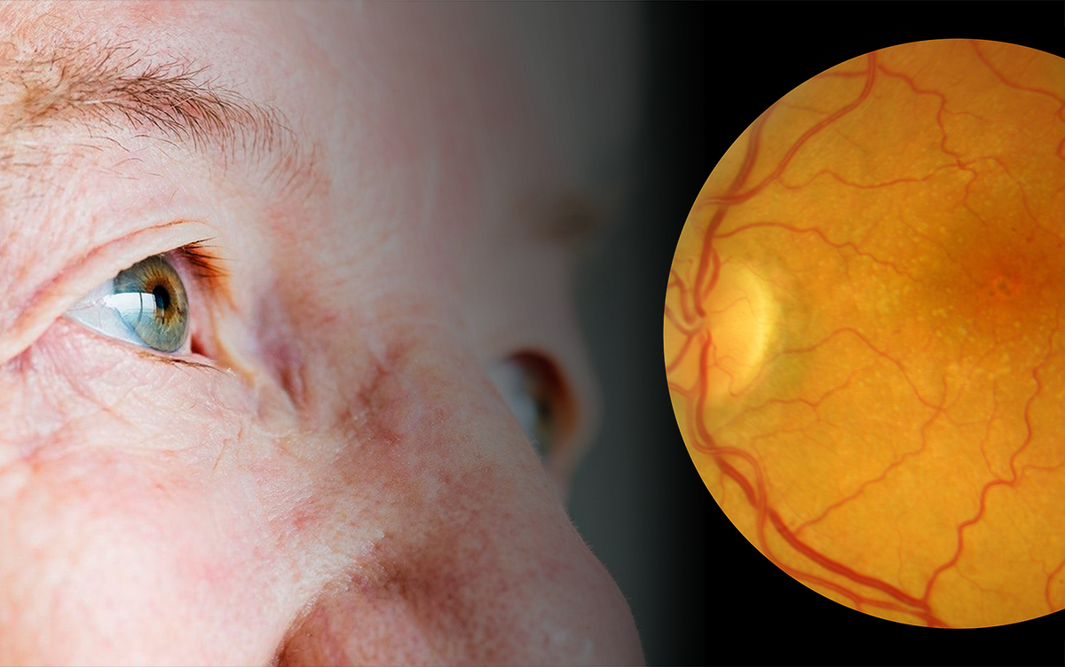 Часто человек замечает, что зрение стало страдать, изображение искажается и обращается к врачу для обследования, узнавая о том, что у него дистрофия сетчатки глаза.