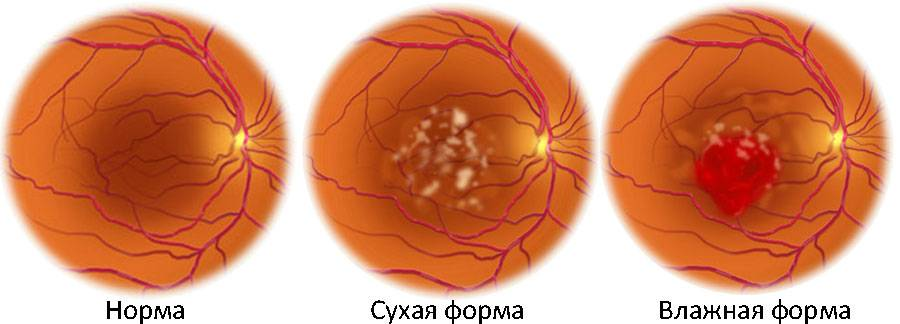 Часто человек замечает, что зрение стало страдать, изображение искажается и обращается к врачу для обследования, узнавая о том, что у него дистрофия сетчатки глаза.-2