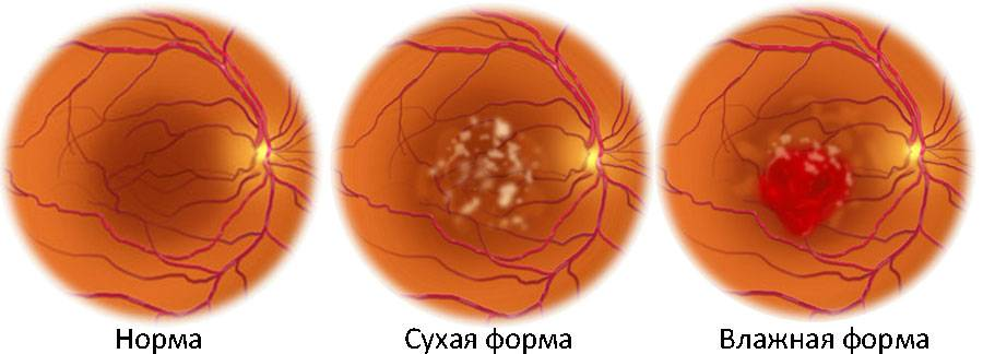 Изображение в глазу пропадает если оно