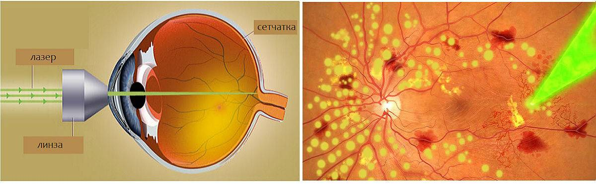 Вылечил сетчатку. Периферическая лазеркоагуляция сетчатки глаза. Периферическая витреохориоретинальная дегенерация сетчатки глаза. Глазное дно отслоение сетчатки. Лазерная коагуляция сетчатки ПВХРД.