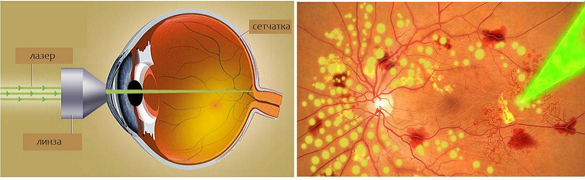 Сетчатка лазерная операция