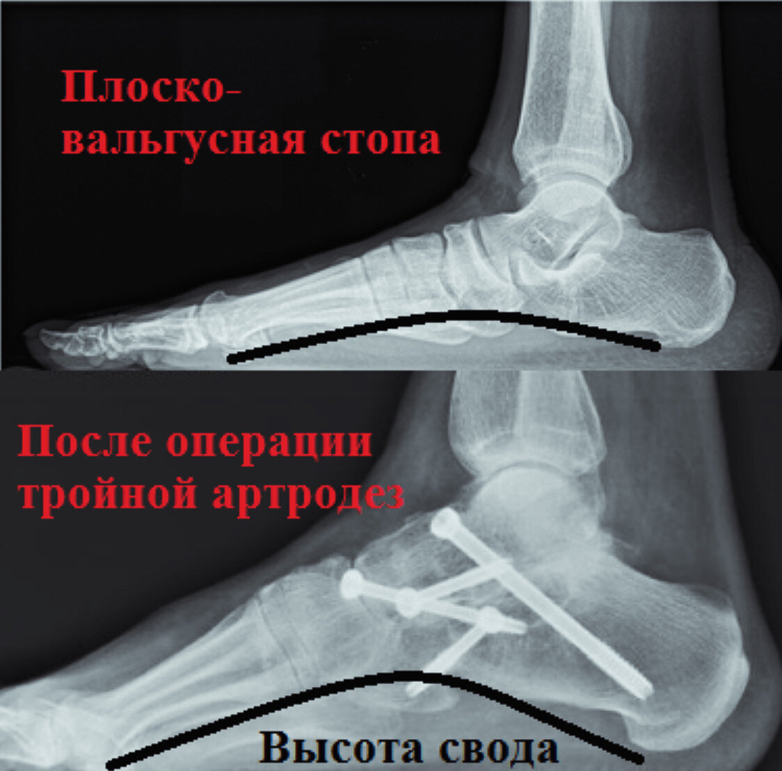 Операция на плоскостопие до и после