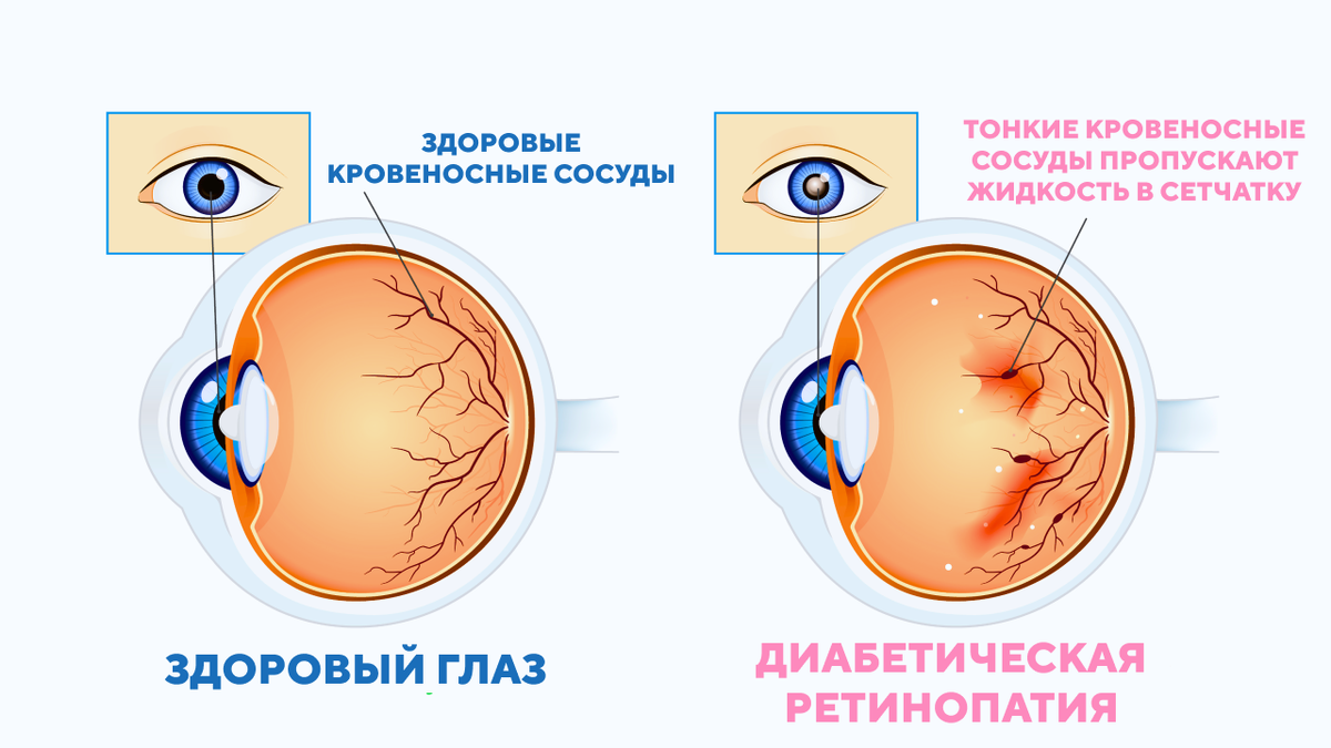 Сахарный диабет и зрение. Диабетическая ретинопатия.