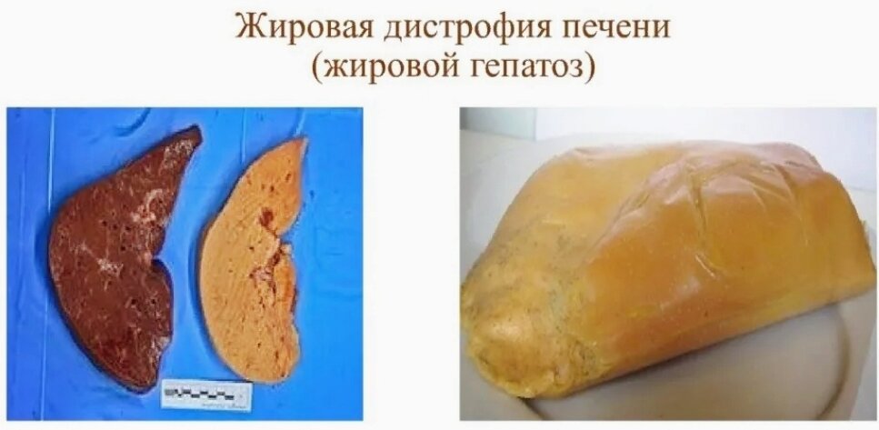 В конечном итоге жировой гепатоз может привести к циррозу печени