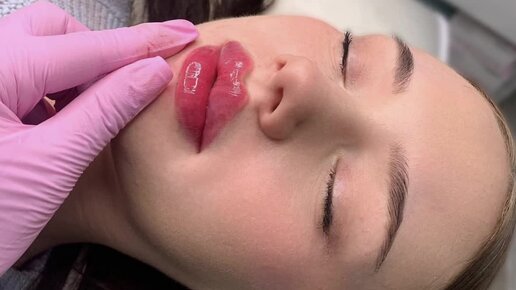 Губы косметология. Анестезия для зубов распухло лицо. Пациент губа. Тату макияж. Пациент губа.