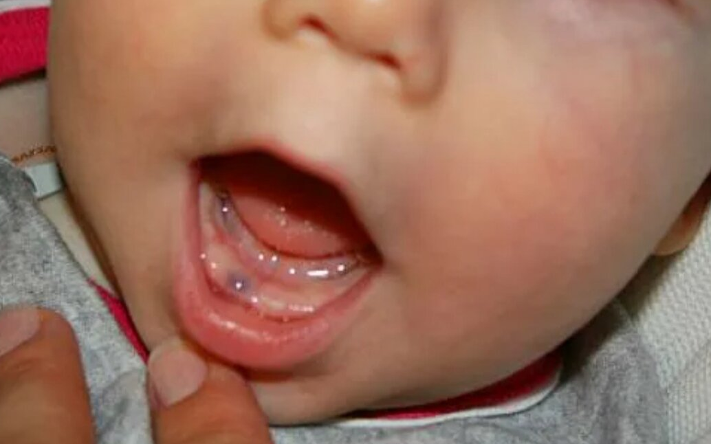 Иногда во рту у ребенка на месте будущих зубов появляются синие шишки. Это так называемые гематомы прорезывания, или эрупционные кисты.