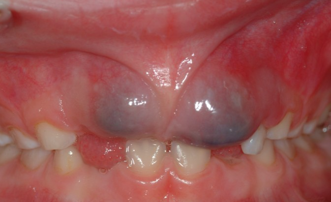 Киста (гематома) прорезывания у детей. Симптомы и лечение