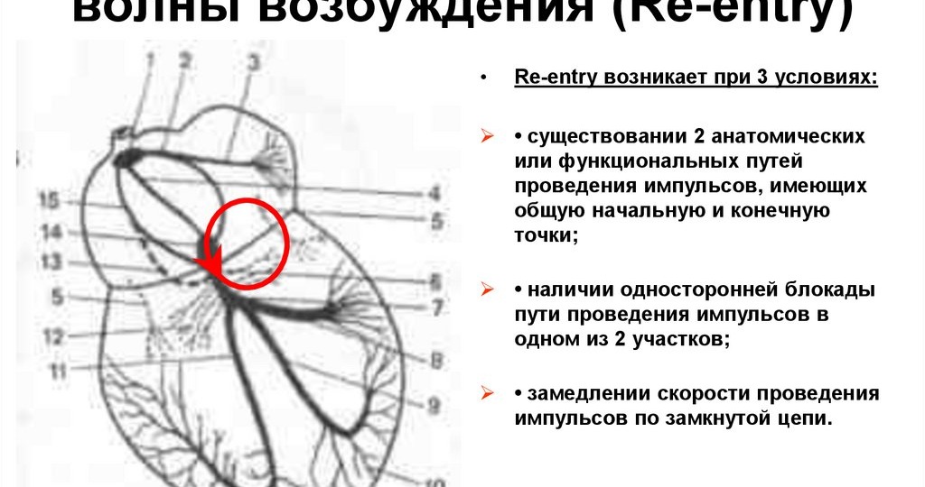 Пароксизмальная тахикардия. Как снять приступ самостоятельно, и как от неё избавиться навсегда