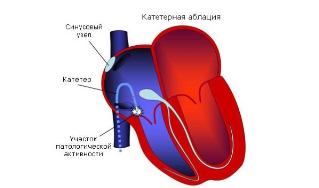 Тахикардия: симптомы и лечение, чем опасна болезнь