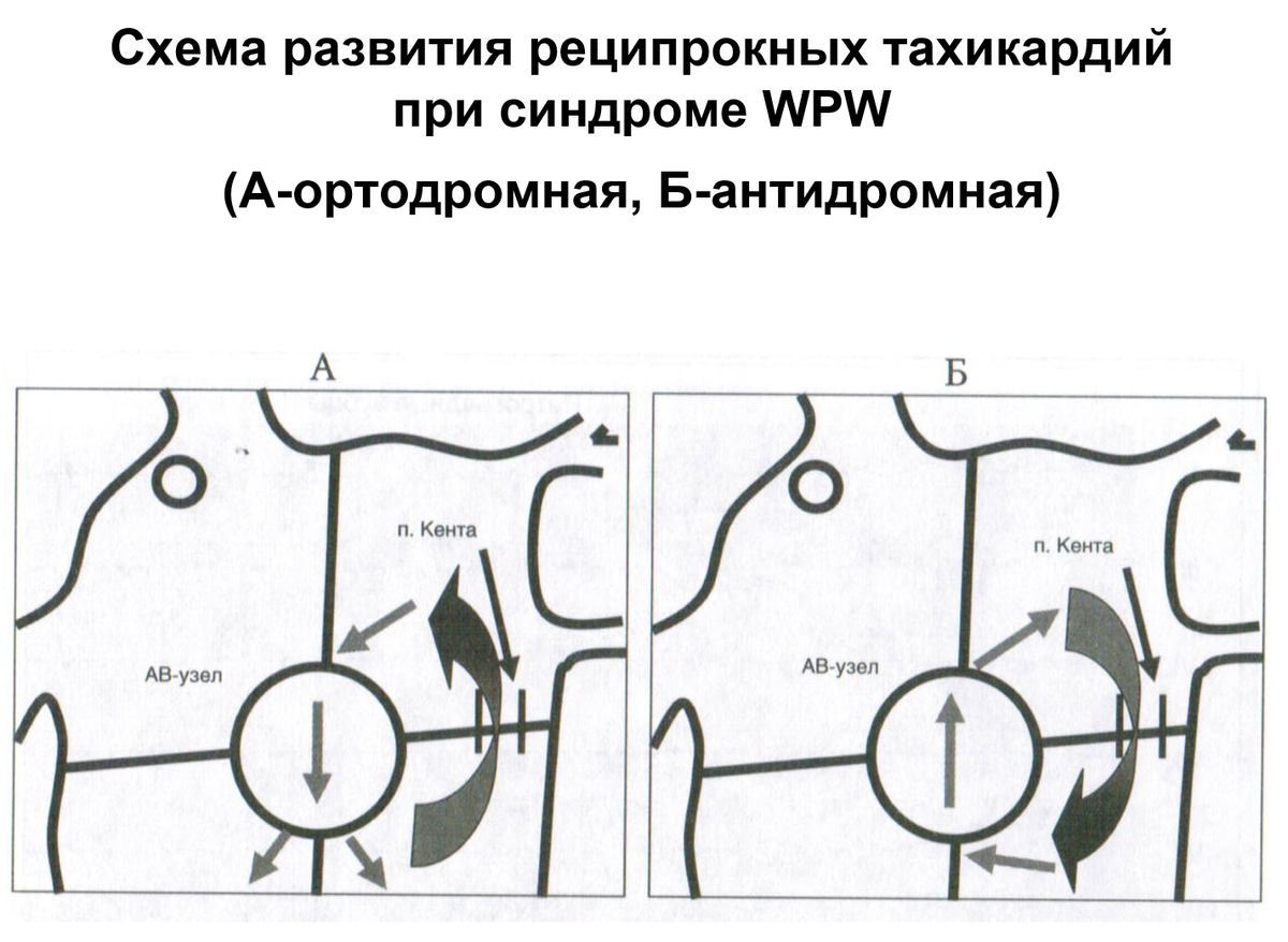 Здесь схематично изображены 4 камеры сердца (предсердия и желудочки), а кружком - предсердно-желудочковый узел. Изображена также замкнутая траектория движения импульса, проходящая в том числе через этот узел. Дыхательные маневры позволяют затормозить импульс именно в этом участке, в итоге всё движение останавливается 