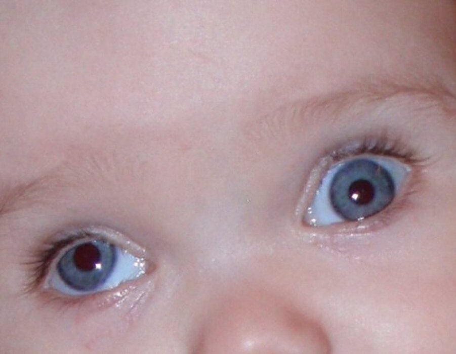 Ребенок косит глазки. Косоглазие гипотропия. Косоглазие (страбизм) у новорожденного. Глаза новорожденного. Глаза у детей до года.