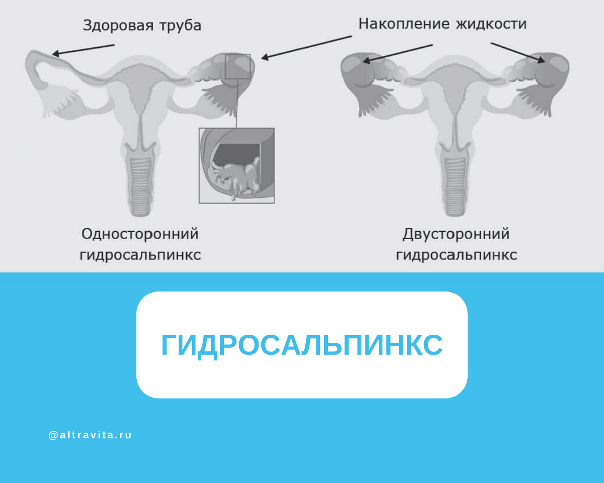 Гидросальпинкс мкб 10