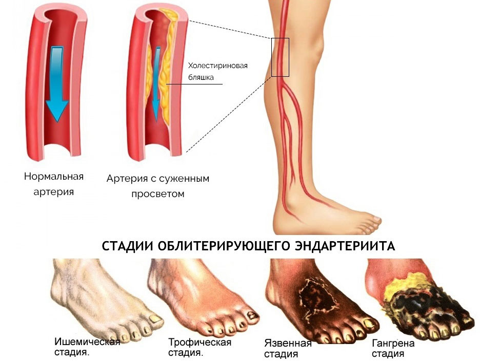 Гангрена нижних конечностей