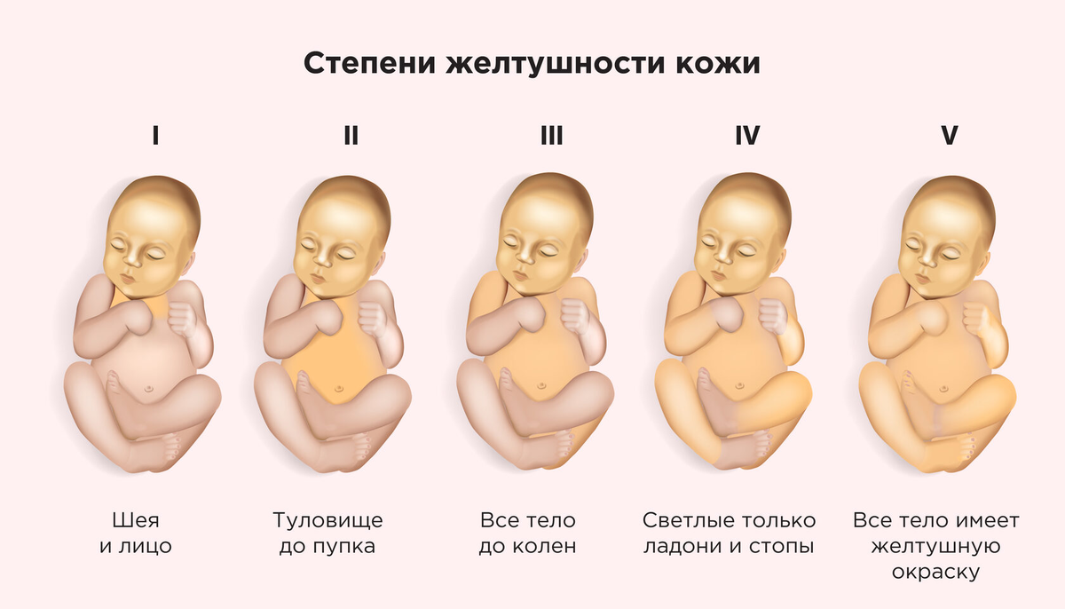 Причины развития желтухи новорожденных. Желтушка у новорожденного. Шкала Крамера при желтухе. Шкала Крамера при желтухе новорожденных.