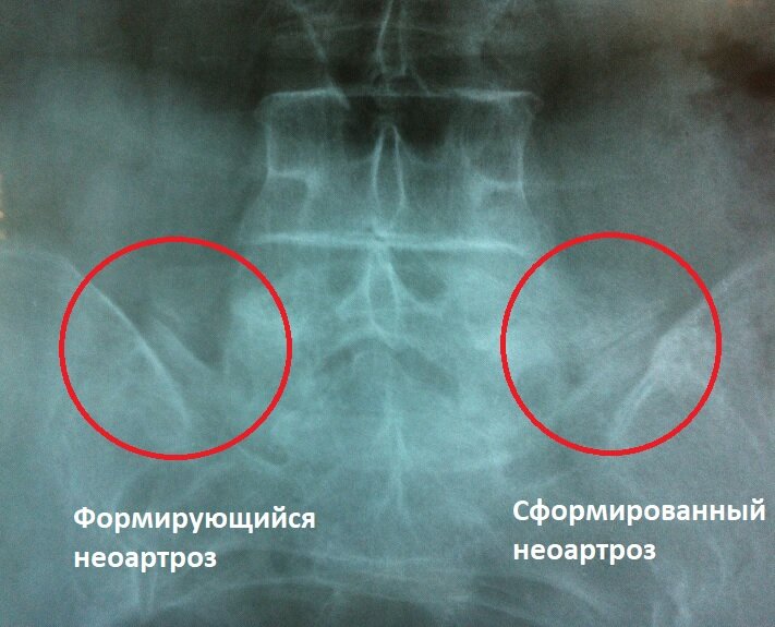 Ребенок после рентгена. Провалился позвоночник в спину диагноз. Кастельви сакрализация.