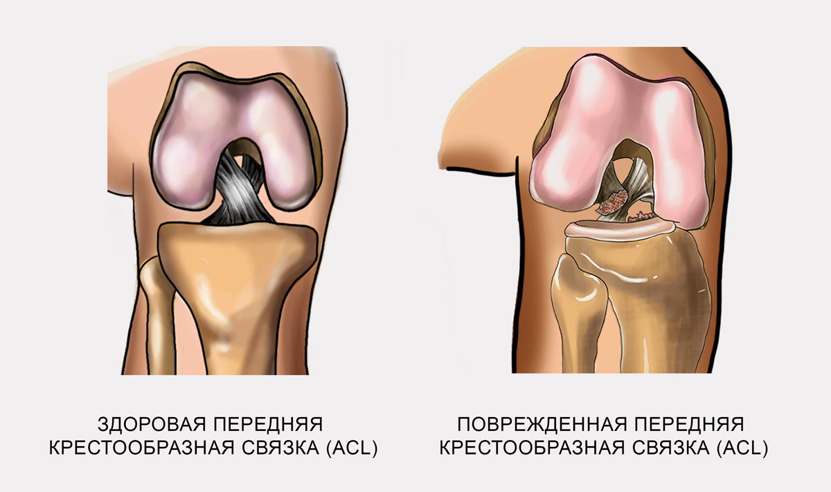 Симптомы крестообразной связки коленного сустава. Передняя крестообразная связка коленного сустава разрыв. Разрыв связок ПКС коленного сустава. Повреждение передней крестообразной связки коленного сустава. Крестообразная связка колена симптомы.
