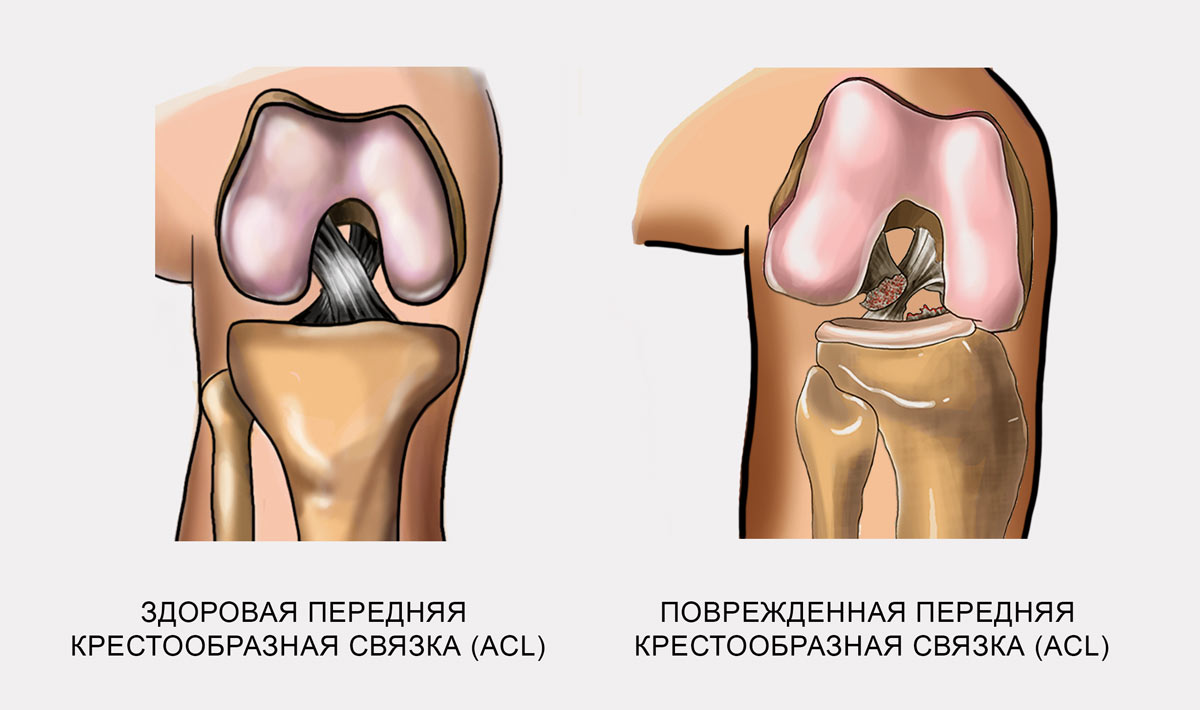 Крестообразный сустав. Разрыв связок ПКС коленного сустава. Повреждение передней крестообразной связки коленного сустава. Крестообразная связка колена симптомы. Повреждение и разрыв крестообразной связки коленного сустава.