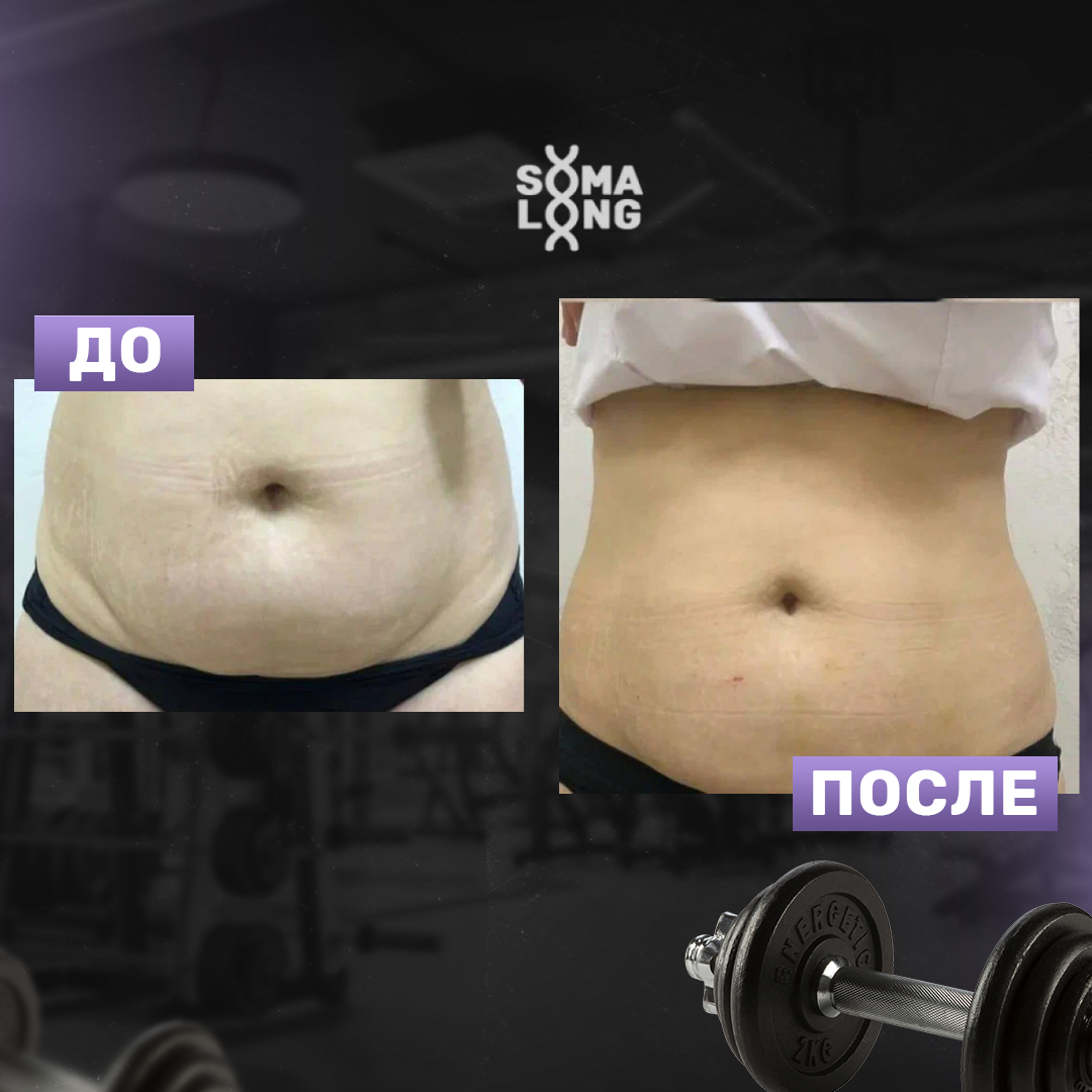 До/после применения SomaLong