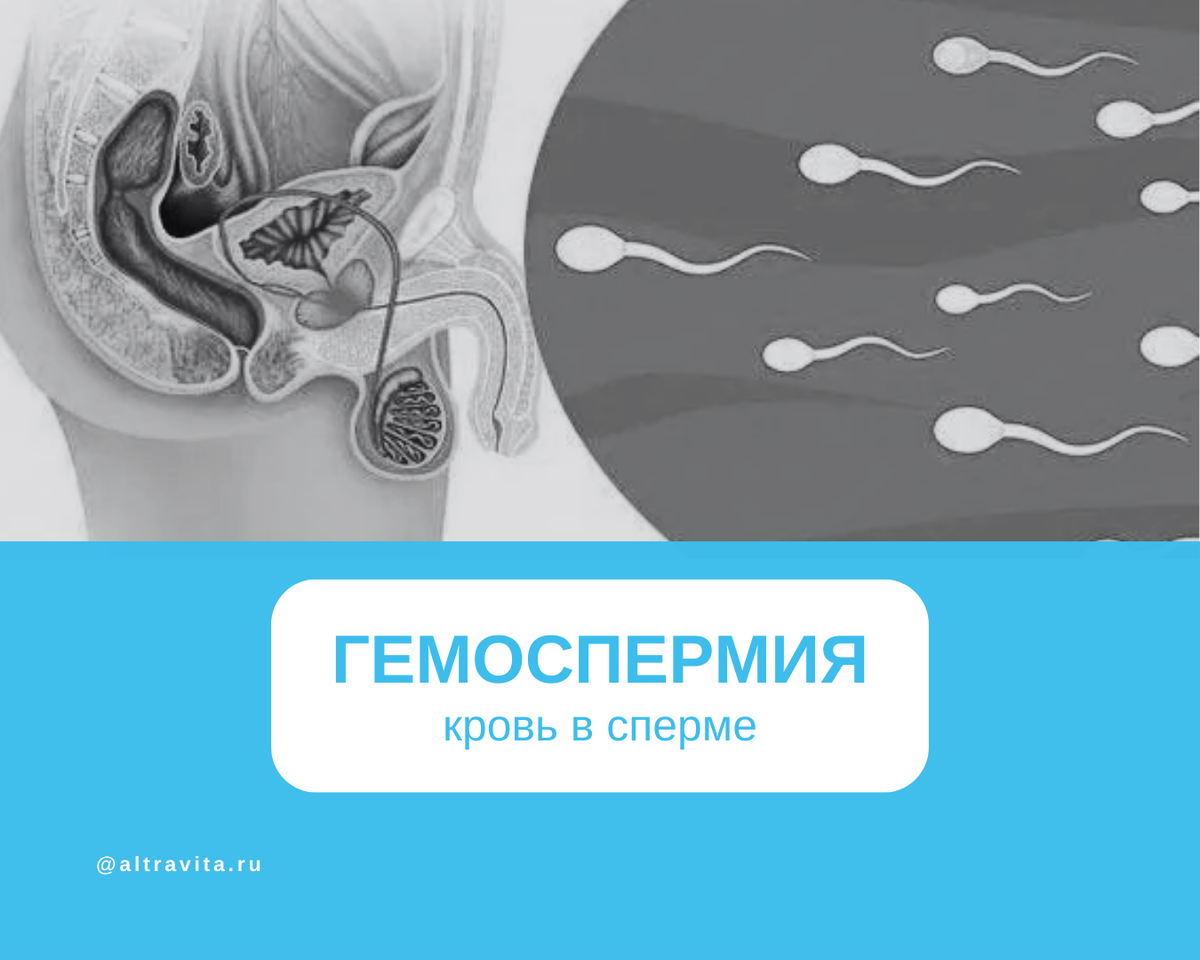 Гемоспермия (кровь в сперме)