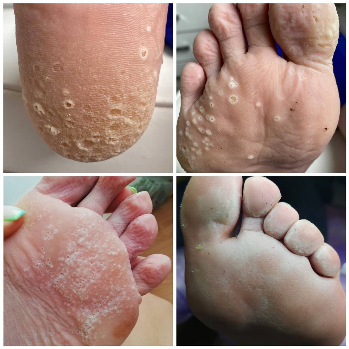 МЕЛКОТОЧЕЧНЫЙ КЕРАТОЛИЗ | Центр подологии №1 PodoFocus | Дзен