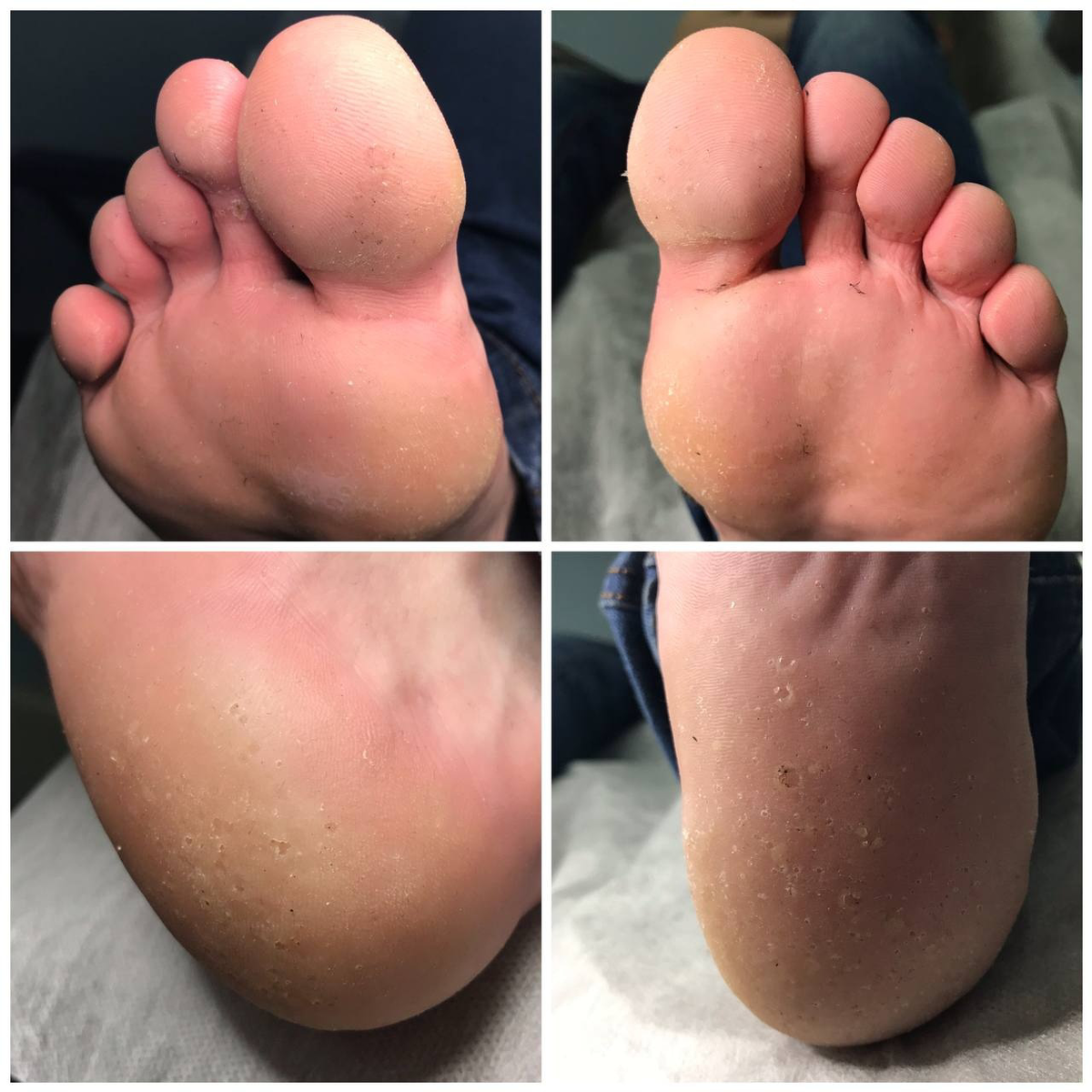 МЕЛКОТОЧЕЧНЫЙ КЕРАТОЛИЗ | Центр подологии №1 PodoFocus | Дзен