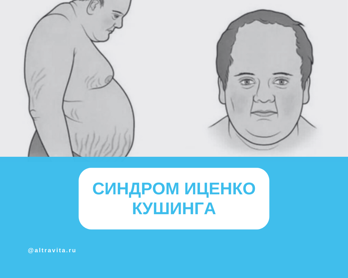 Синдром Иценко Кушинга | Клиника «АльтраВита» | Дзен