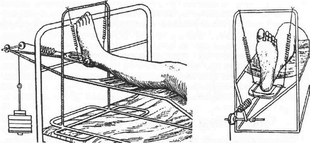 Пяточное вытяжение. Шина Беллера для скелетного вытяжения. Вытяжение при переломе большеберцовой кости. Скелетное вытяжение голени. Скелетное вытяжение при переломе мыщелков большеберцовой кости.