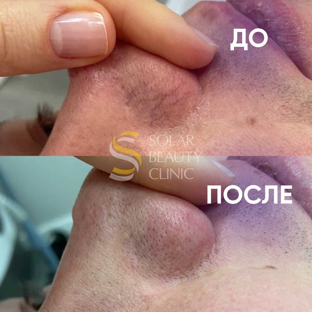 Как убрать сосудистые сетки/звездочки? | Solar Beauty Clinic | Дзен