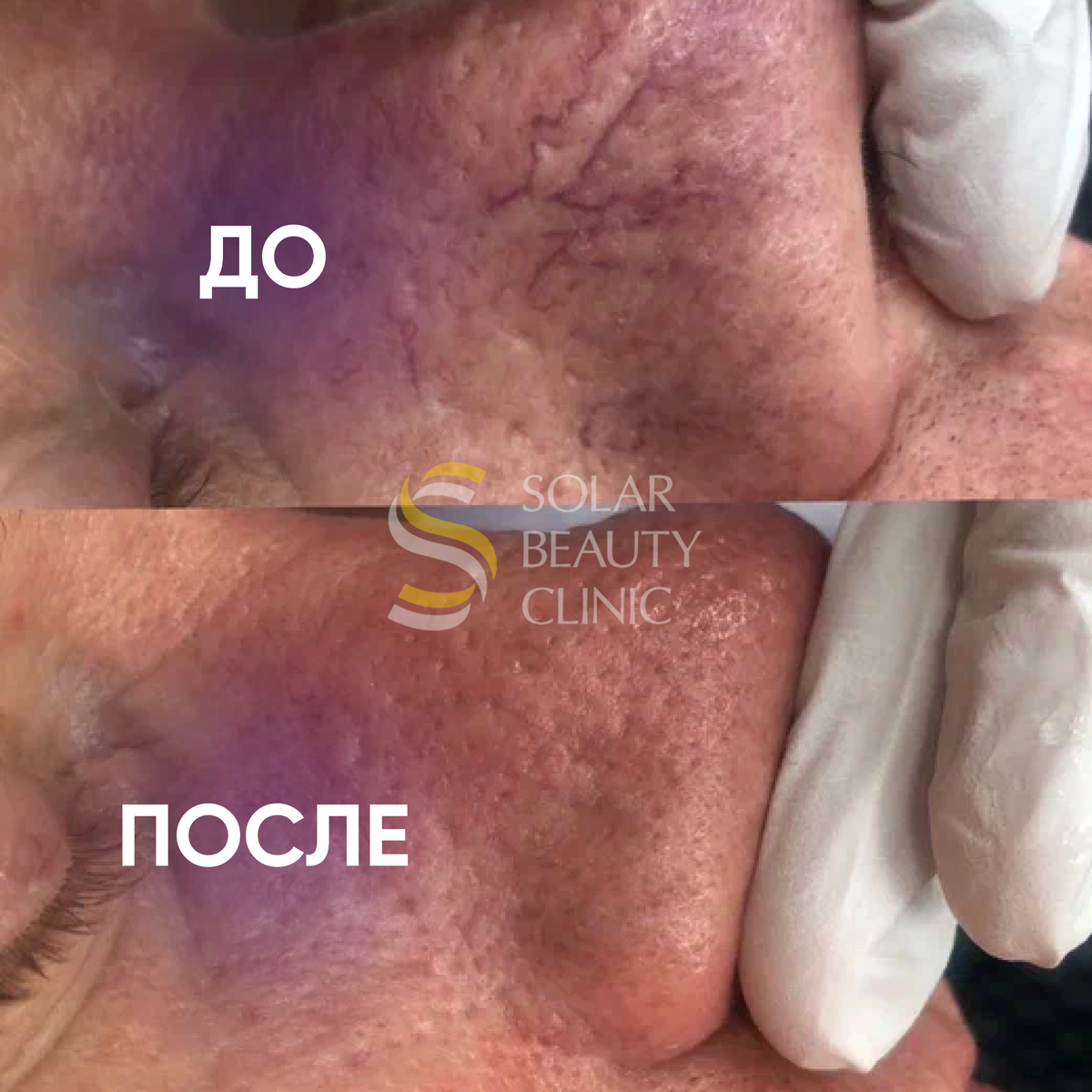 Как убрать сосудистые сетки/звездочки? | Solar Beauty Clinic | Дзен