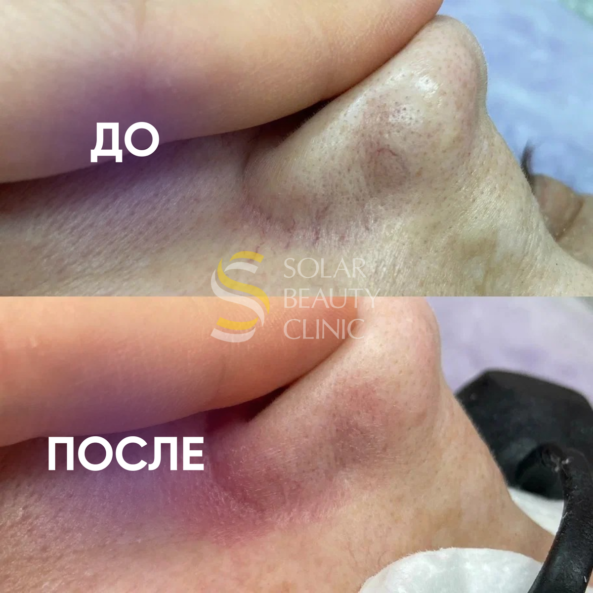 Как убрать сосудистые сетки/звездочки? | Solar Beauty Clinic | Дзен