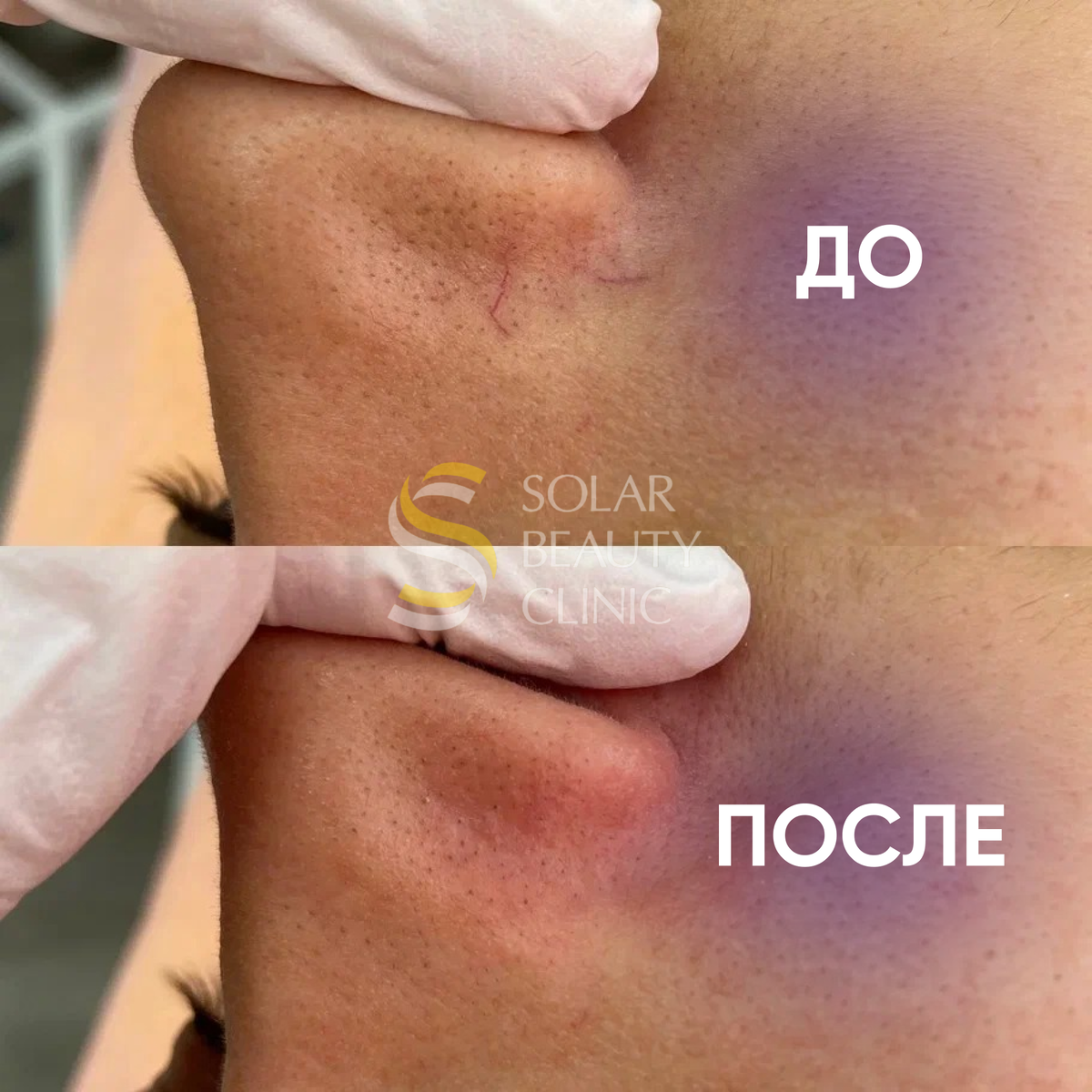 Как убрать сосудистые сетки/звездочки? | Solar Beauty Clinic | Дзен